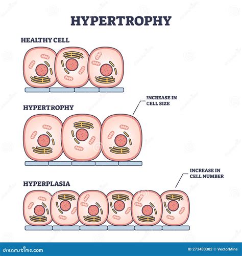 Hypertrophy .